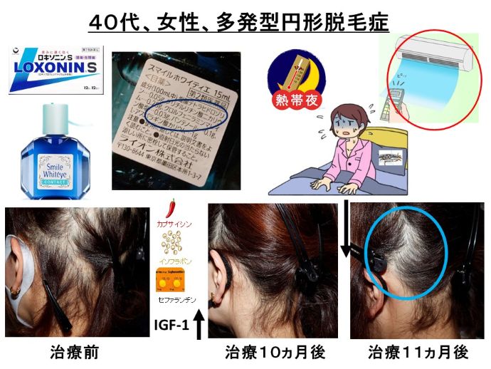 円形脱毛症　病院